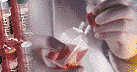 Cervical Dysplasia cell culture